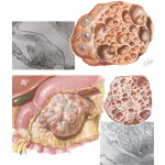 Cystic Tumors: Cystadenoma and Cystadenocarcinoma
