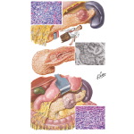 Islet Cell Tumors: Adenomas and Carcinoma