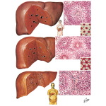 The Liver In Heart Failure: Cardiac Liver and Shock