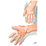 Early and Moderate Hand Involvement In Rheumatoid Arthritis