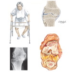 Osteoarthritis of the Knee