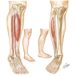 Exertional Compartment Syndromes