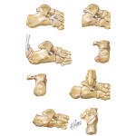 Fractures of the Calcaneus