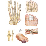 Metatarsal and Phalangeal Injuries