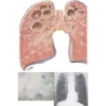 Pulmonary Tuberculosis: Extensive Cavitary Disease