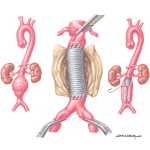 Surgical Management of Abdominal Aortic Aneurysm