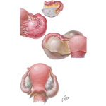 Chronic Pelvic Inflammatory Disease