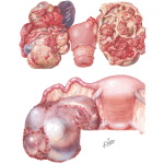 Ovarian Tumors