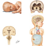 Hydrocephalus