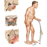 Pituitary Adenomas