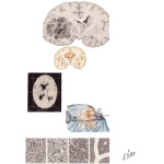 Gliomas