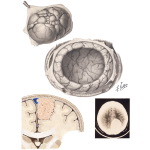 Meningiomas