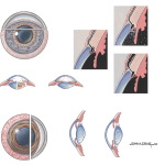 Glaucoma