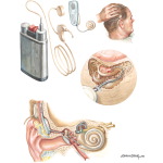 Cochlear Implants