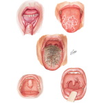 Common Oral Lesions