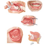 Cancer of the Oral Cavity and Oropharynx