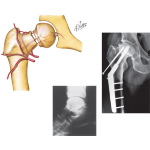 Osteonecrosis After Fracture