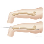 Treatment of Osteogenesis Imperfecta By Intramedullary Fixation