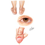 Reactive Arthritis