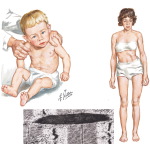 Nemaline Myopathy