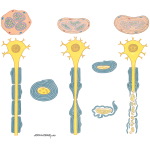 Nerve Injury In Compression Neuropathy
