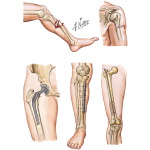 Direct Causes of Osteomyelitis