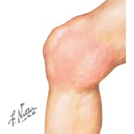 Knee Joint Swollen and Held In a Flexed Position