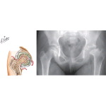 Osteonecrosis and Hip Arthropathy Following Septic Arthritis