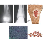 Nonossifying Fibroma