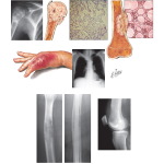 Tumors Metastatic to Bone