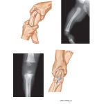Fracture In Abused Children