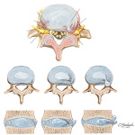 Lumbar Disk Herniation