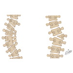 Congenital Scoliosis