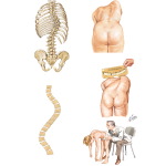 Scoliosis