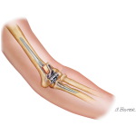 Prosthesis for Total Elbow Arthroplasty