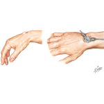 Ganglion of Wrist