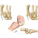 metacarpal