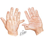 Polydactyly