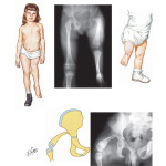 Illustration of Proximal Femoral Focal Deficiency (PFFD) from the Netter Collection