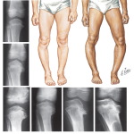 Infantile Tibia Vara
