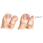 Ingrown Toenail