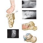 Tarsal Coalition