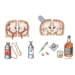 Epilepsy