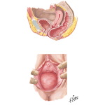 Rectocele Prolapse