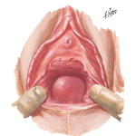 Inclusion Cyst