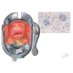 Vaginitis: Bacterial (Nonspecific) and Bacterial Vaginosis