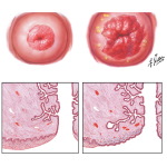 Cervical Ectropion Pictures