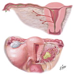 Endometritis