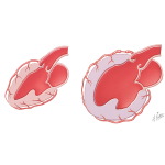 Congestive Heart Failure