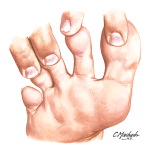 Changes In Skin Color In the Diabetic Foot